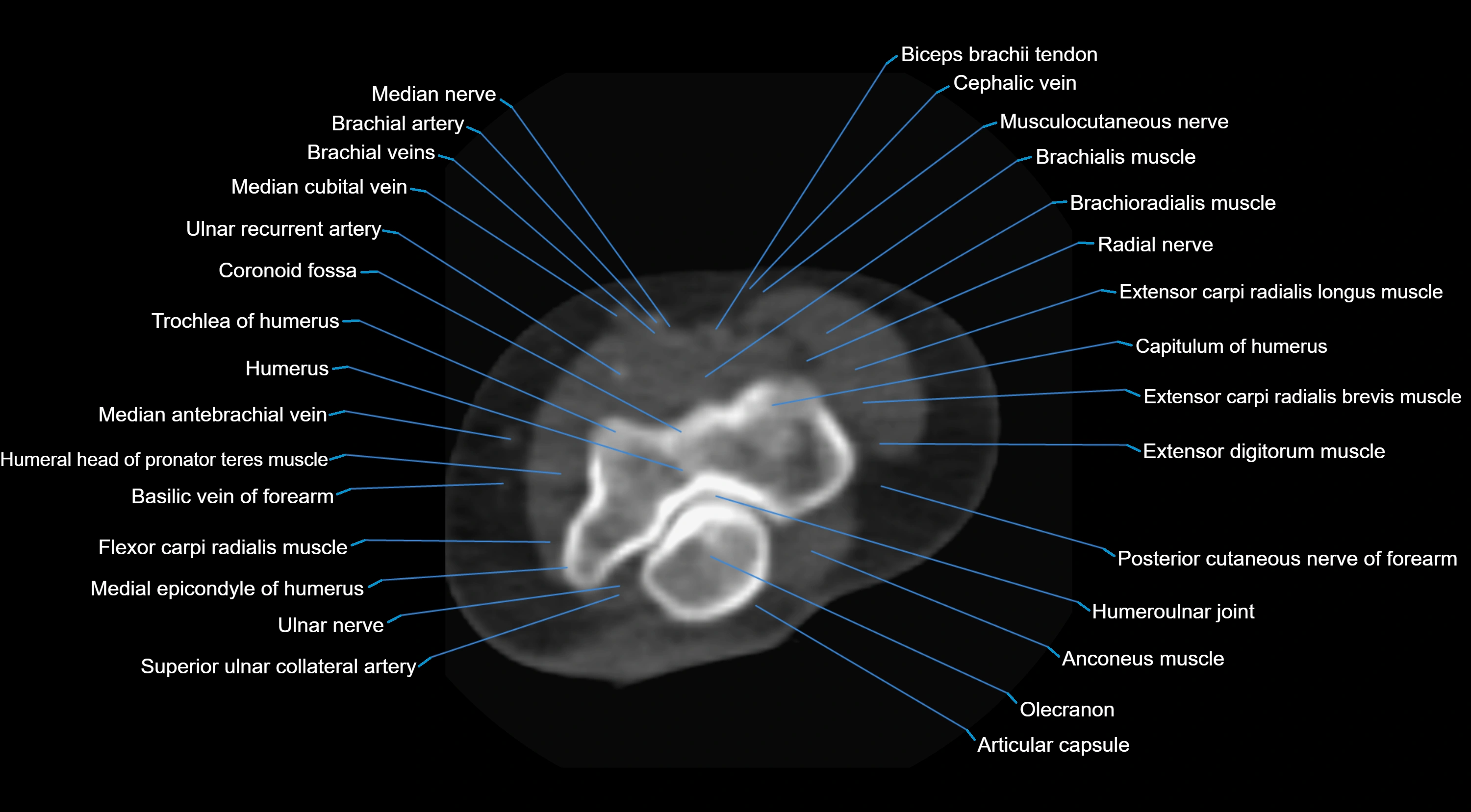 CT elbow axial  cross sectional anatomy labelled  radiology image -00021.webp